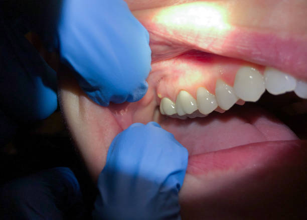Best Emergency Denture Repair in Lake Dallas, TX